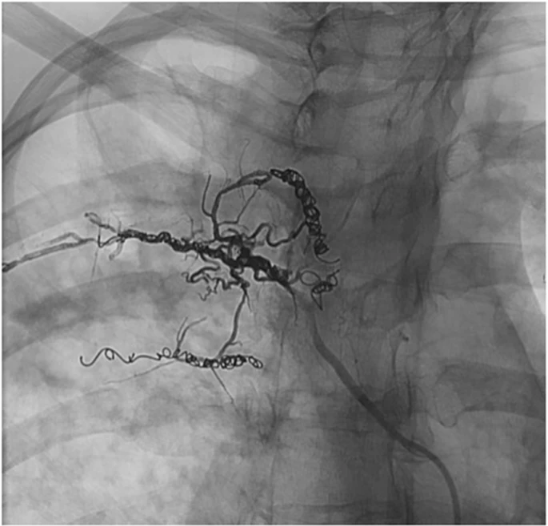 CVIR Endovascular (Jim Reekers, Editor-in-Chief) (@cvirendo) on Twitter photo Have you read this paper on recurrent massive hemoptysis in a patient with cystic fibrosis: balloon assisted Onyx #embolization after bronchial artery coil recanalization: cvirendovasc.springeropen.com/articles/10.11… <a href="/RaghavMattay/">Raghav Mattay</a> <a href="/RichardShlansky/">Richard Shlansky-Goldberg</a> <a href="/MdPukenas/">Bryan Pukenas, MD</a>
#BronchialArteryEmbolization #IRad Have you read this paper on recurrent massive hemoptysis in a patient with cystic fibrosis: balloon assisted Onyx #embolization after bronchial artery coil recanalization: cvirendovasc.springeropen.com/articles/10.11… <a href="/RaghavMattay/">Raghav Mattay</a> <a href="/RichardShlansky/">Richard Shlansky-Goldberg</a> <a href="/MdPukenas/">Bryan Pukenas, MD</a>
#BronchialArteryEmbolization #IRad