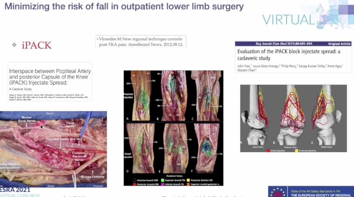 claralexlobo's tweet photo. - #iPACK presents a good pain control
- #LIA + #ACB - better pain control! vs #LIA 
- #genicularnerveblock - comparable to #LIA in analgesia https://t.co/vbhWd0PWsS