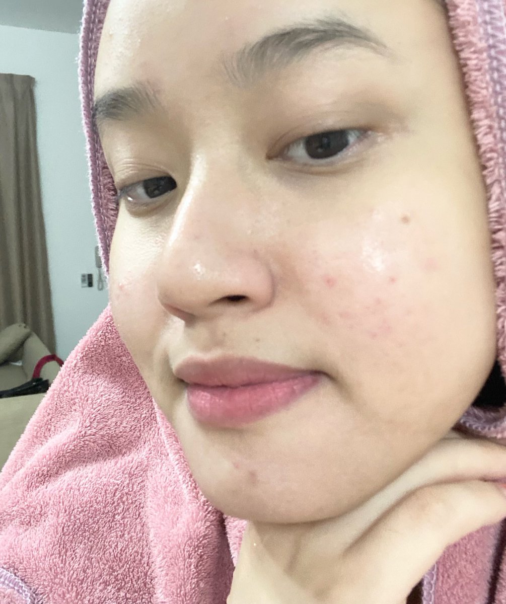 amyranadyaa's tweet photo. look at my old skin... clogged pores, ada blackhead &amp; whitehead 😩

but after 1month+ using Zarzou Daily Deep Cleanser, result dia amazing 😭 https://t.co/vqn3kIAMPA
