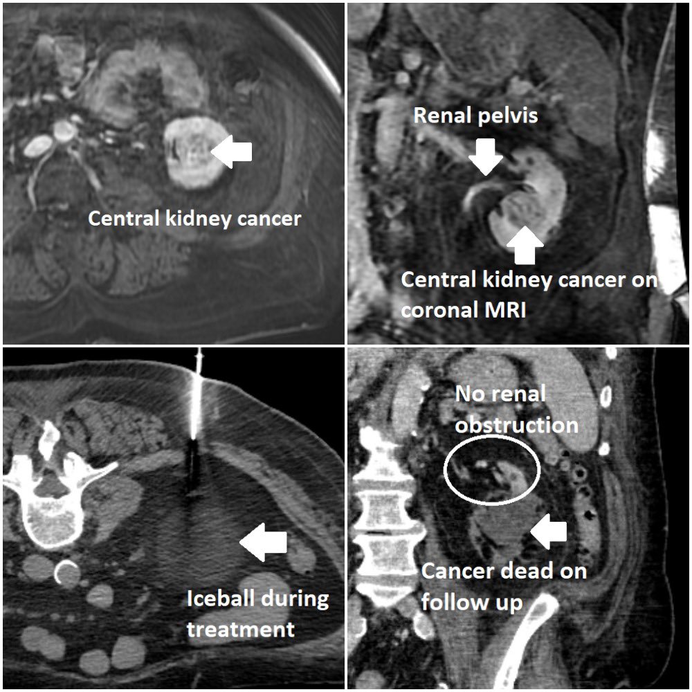 Central kidney #cancer in a patient who was offered total nephrectomy treated here by interventional radiology (#IRad) using CT-guided, percutaneous cryoablation with a complete response, sparing of the kidney, and no injury to the collecting system.