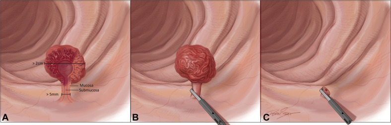 VideoGIE Journal (@videogie) on Twitter photo VideoGIE Editor's Choice: "Endoscopic resection of large Paris 0-Ip pedunculated polyps: video demonstration of recent U.S. Multi-Society Task Force recommendations on resection and removal for general endoscopists" by Nauroz Syed and Matthew T. Moyer. videogie.org/article/S2468-… VideoGIE Editor's Choice: "Endoscopic resection of large Paris 0-Ip pedunculated polyps: video demonstration of recent U.S. Multi-Society Task Force recommendations on resection and removal for general endoscopists" by Nauroz Syed and Matthew T. Moyer. videogie.org/article/S2468-…