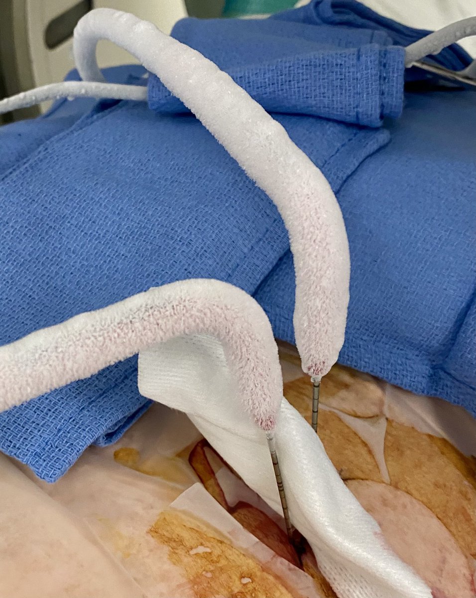 Painless, outpatient, moderate sedation, visible margins, and the only snow we get here in sunny Florida!  Cryoablation is an excellent option for T1a renal cell carcinoma.