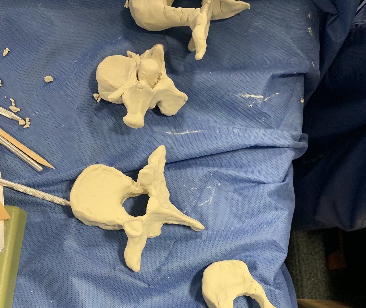 jv coumans (@jvcoumans) on Twitter photo Clay-modeling a lumbar vertebra tests your knowledge of spine anatomy. Thank you @ckleemd for the idea. Congratulations <a href="/MGHNSResidency/">MGHNeurosurgResidency</a> on the impressive results! <a href="/AtharNMalik/">Athar N Malik, MD, PhD</a> @kmaessuman <a href="/MGHNeurosurg/">MGH Neurosurgery</a> <a href="/VictoriaEClark/">Victoria E. Clark, MD, PhD</a> <a href="/ndsisterson/">Nathaniel D. Sisterson</a> Clay-modeling a lumbar vertebra tests your knowledge of spine anatomy. Thank you @ckleemd for the idea. Congratulations <a href="/MGHNSResidency/">MGHNeurosurgResidency</a> on the impressive results! <a href="/AtharNMalik/">Athar N Malik, MD, PhD</a> @kmaessuman <a href="/MGHNeurosurg/">MGH Neurosurgery</a> <a href="/VictoriaEClark/">Victoria E. Clark, MD, PhD</a> <a href="/ndsisterson/">Nathaniel D. Sisterson</a>