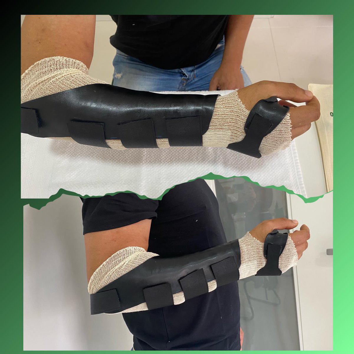 Órtese para bloqueio de prono e supino.