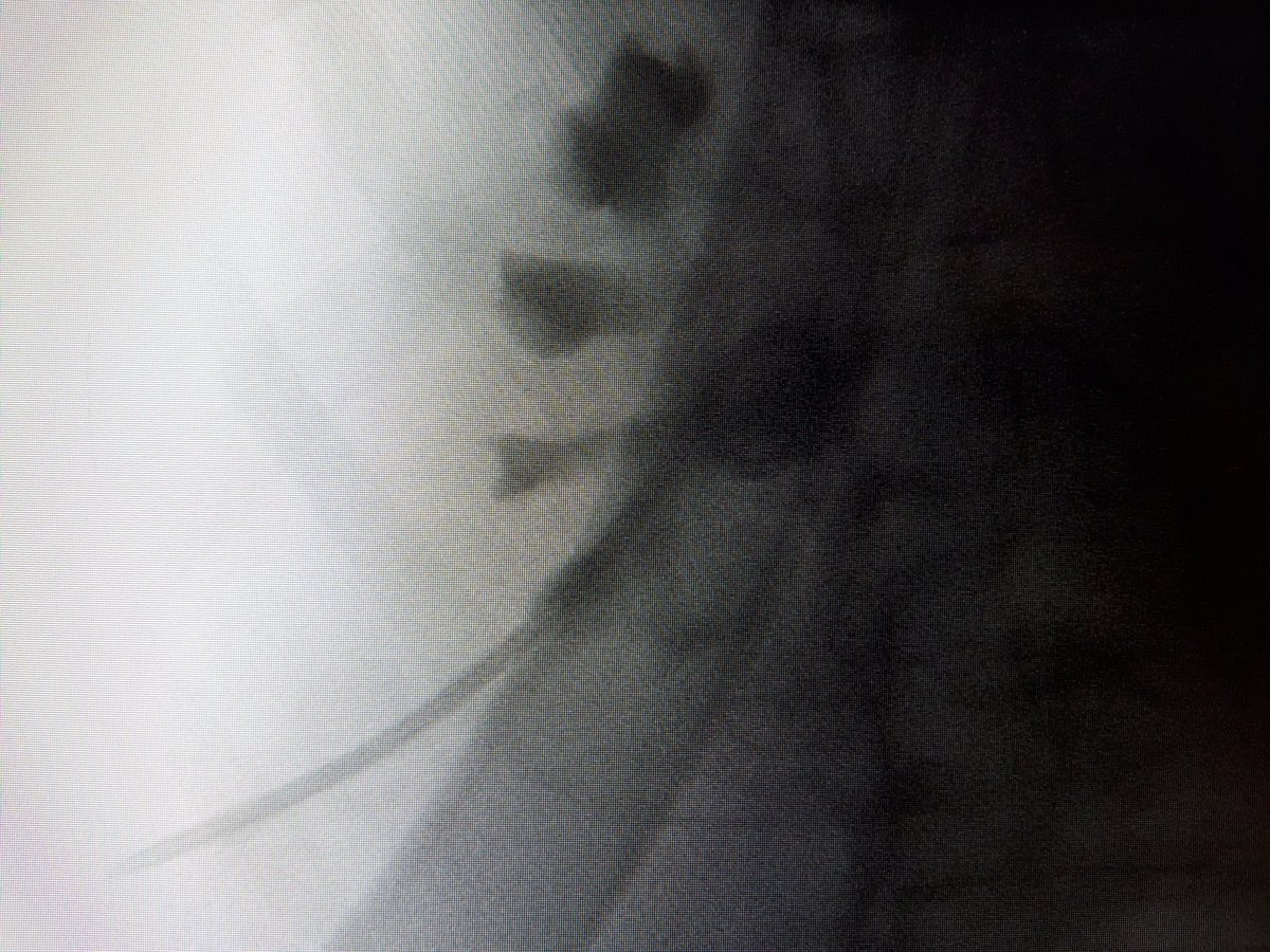 vdconinck's tweet photo. Today we placed 8 nephrostomy tubes: 1 PCNL and 7 emergencies. Our nurses and anesthetists were grateful that we all placed them in supine position. Thank you @GuidoGiusti for teaching this technique in 2018. I recommend Drainpatch by Bedal to prevent accidental tube dislodgement https://t.co/0fjcTxNQtO