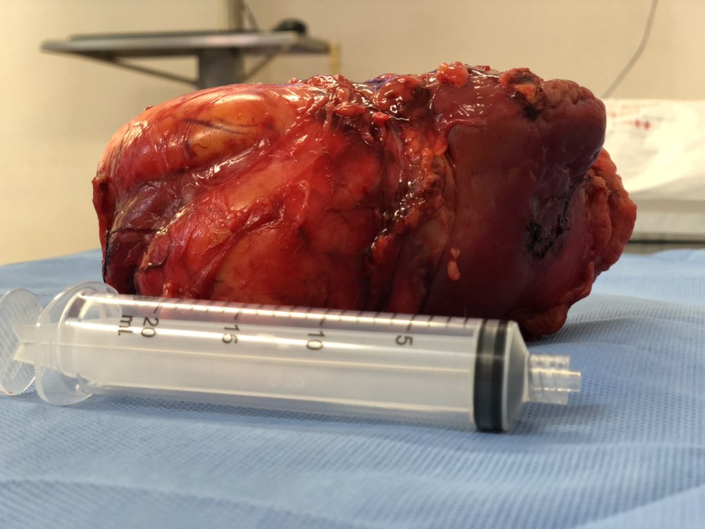 umaemac's tweet photo. Nefrectomia radical izquierda en mujer de 46 años con probable angiomiolipoma de riñón izquierdo #urology #kidney https://t.co/EMjETdK4dr