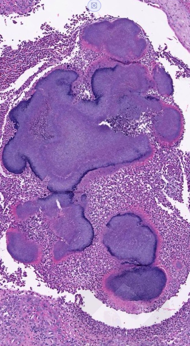 JMGardnerMD's tweet photo. 50 yo man with draining nodule on lower mucosal lip. Your diagnosis? WSI digital slide: https://t.co/xypIHnEa90. Video &amp; answer: https://t.co/Yyh0Wu01d2. I LOVE that bright pink stuff! 😍 #pathology #pathologists #pathTwitter #dermpath #dermatology #dermatologia #dermtwitter https://t.co/bVRei6QRpU