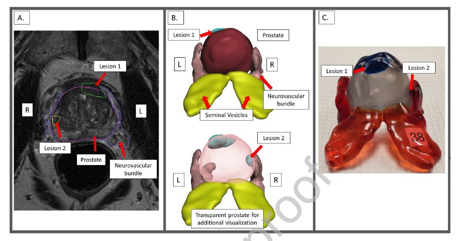 radiolobt's tweet image. Comparison of Multi-Parametric MRI of the Prostate to 3D Prostate Computer Aided Designs and 3D-Printed Prostate Models for Pre-Operative Planning of Radical Prostatectomies: A Pilot Study sciencedirect.com/science/articl… #prostateMRI #prostatecancer #medtwitter