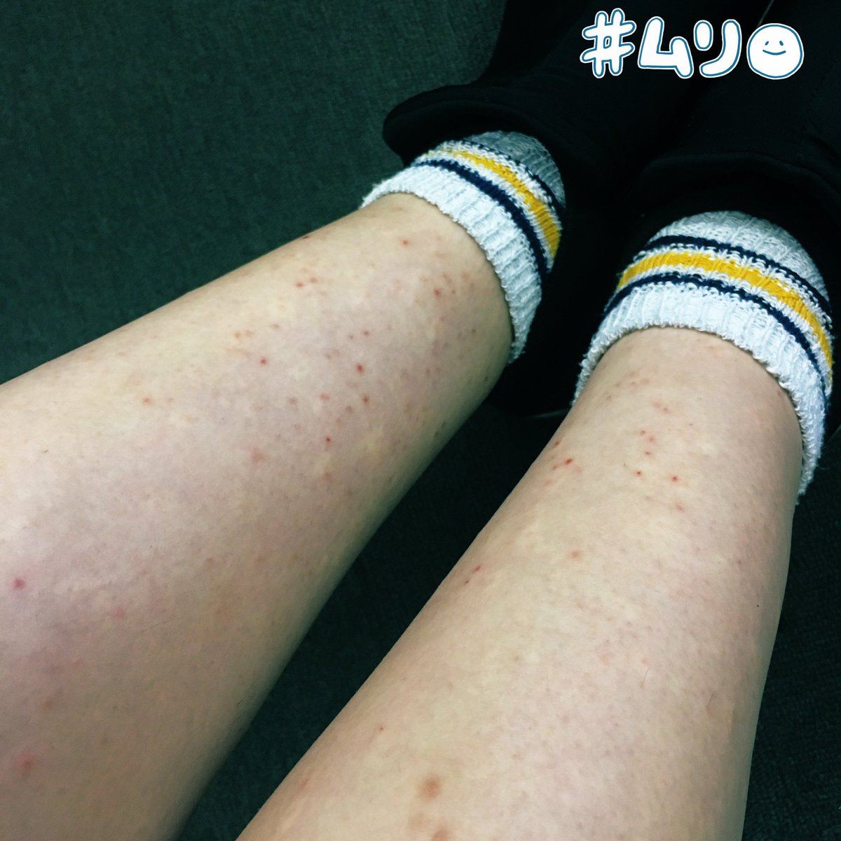 冬眠しました 引き続き ワクチン副反応 ワクチン副作用 ファイザー 1回目 コロナワクチン副反応 写真注意 サムネすみません 9 16 接種18日目 やっと膝下の新規蕁麻疹や湿疹があまり出なくなってきました 跡残りしている惨状がこちら 徐々にひざ