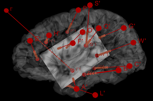 hospitaldelmar's tweet photo. Descubren cómo el #cerebro modula el #corazón

Un estudio liderado por el @Dr_Rocamora permite ver por 1a vez cómo la activación de la #ínsula, un área poco estudiada del cerebro, varía el ritmo cardíaco. Lo publica @ANA_journals

https://t.co/3jNemsS6Wx #epilepsia #cardiologia https://t.co/2wHr6fD6PI