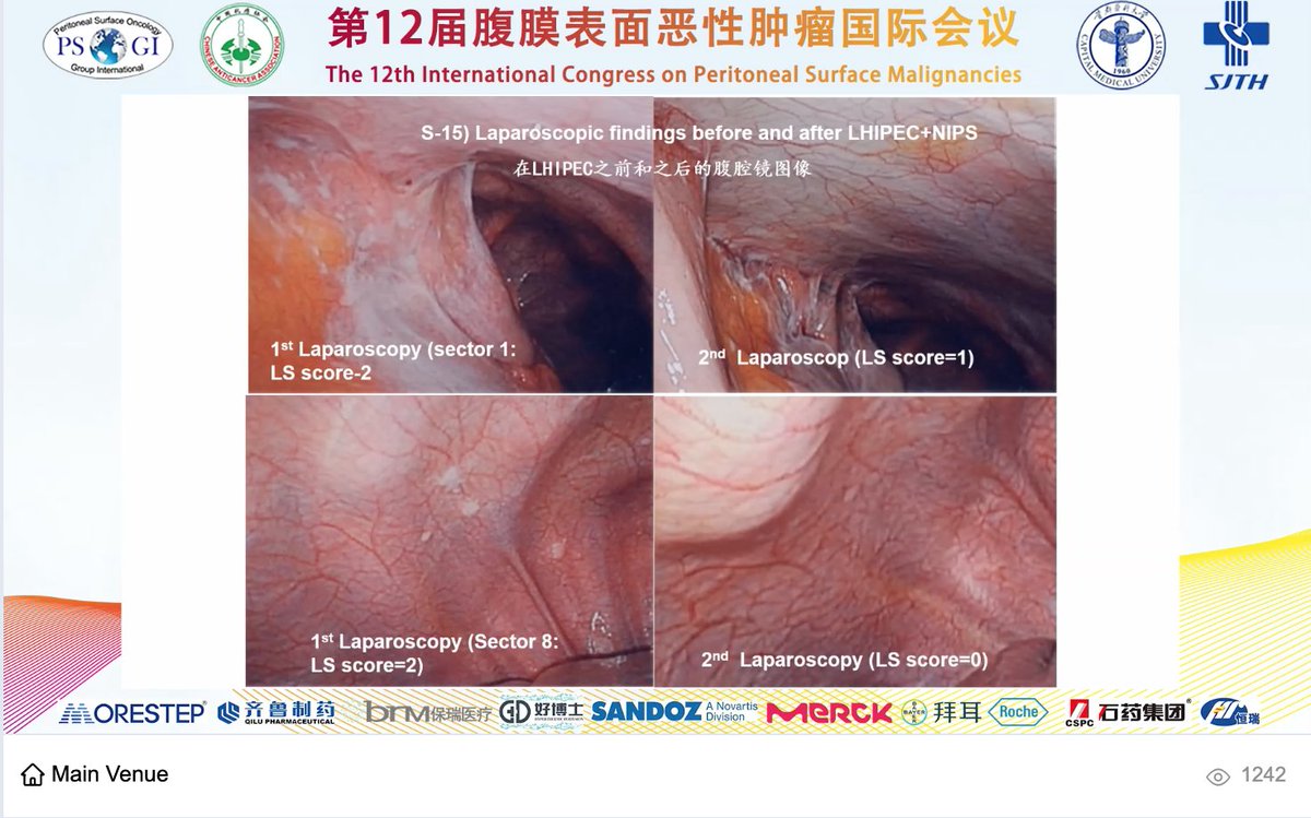 PSOGI_EC's tweet photo. Prof. Yutaka Yonemura 

Laparoscopic HIPEC as neoadjuvant therapy 
Calculating the thermal dose and the response to neoajduvant HIPEC in #gastricPM https://t.co/AQGrHNS6lX
