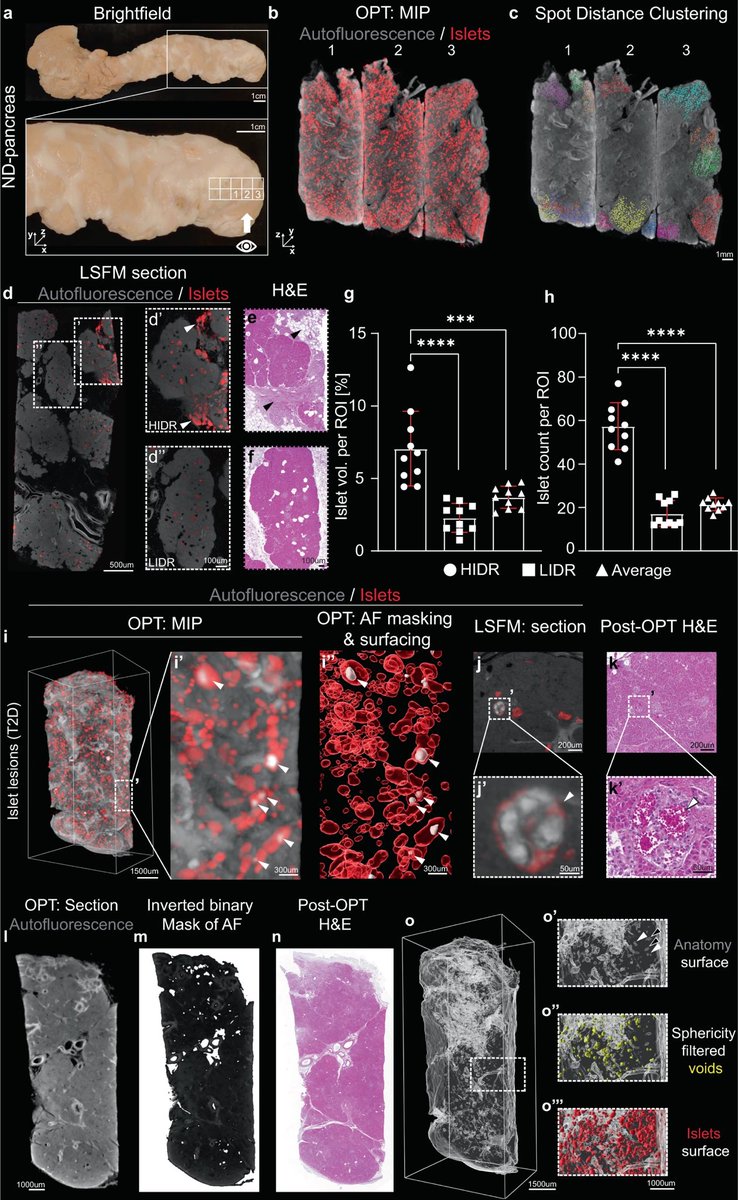 Daniel J Drucker (@danieljdrucker) on Twitter photo Reconstruction of the 3 dimensional anatomy of the human endocrine pancreas #islets <a href="/CommsBio/">Communications Biology</a> nature.com/articles/s4200… Reconstruction of the 3 dimensional anatomy of the human endocrine pancreas #islets <a href="/CommsBio/">Communications Biology</a> nature.com/articles/s4200…
