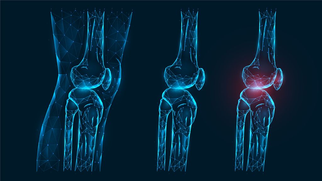 La artrosis te puede dejar sin caminar
