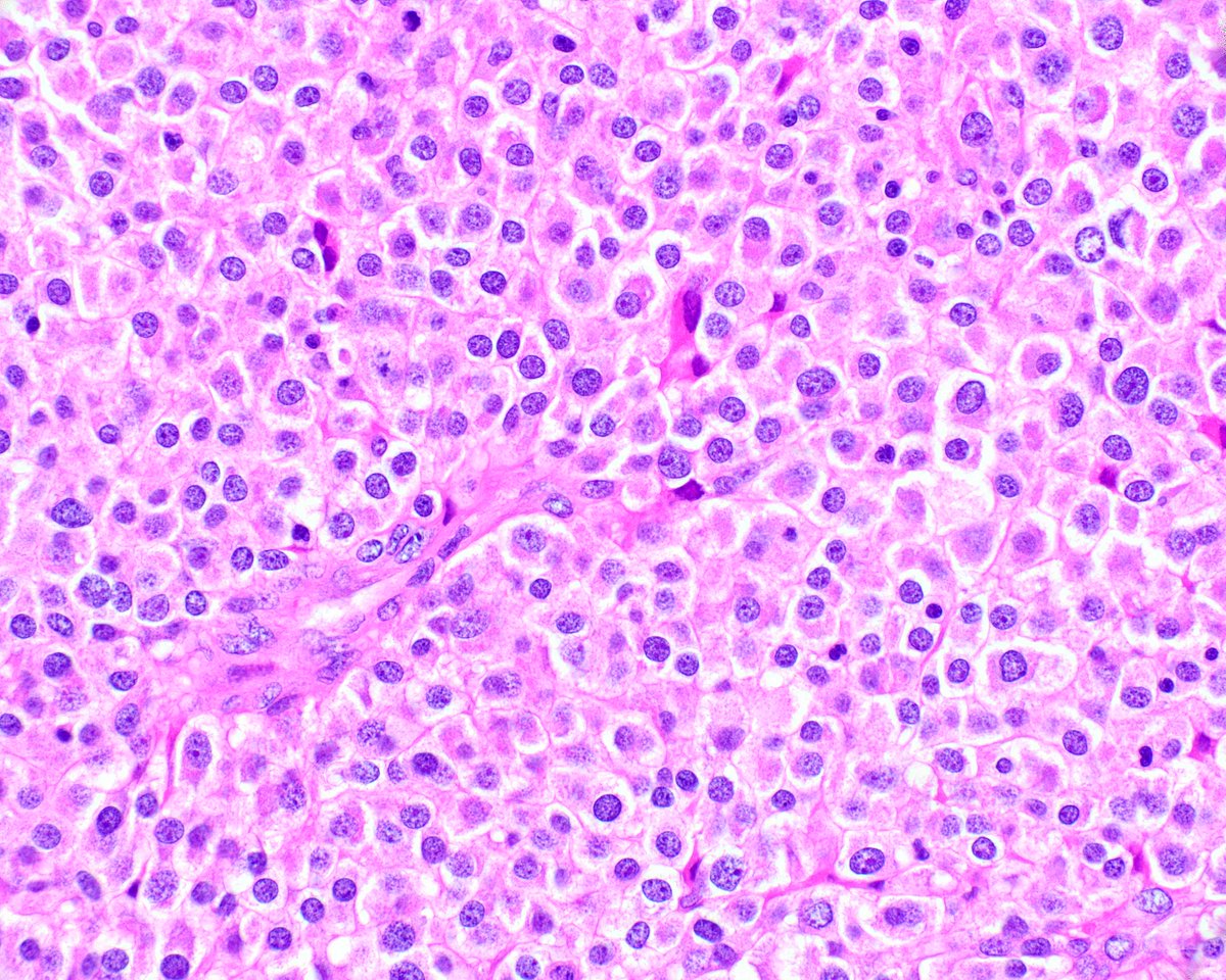This epithelioid gastrointestinal stromal tumor both invades the gastric mucosa and has spread to a lymph node. A succinate dehydrogenase (SDH)-deficient lesion was considered but the SDHB immunostain showed intact expression.  The neoplasm was shown to have a PDGFRA mutation.
