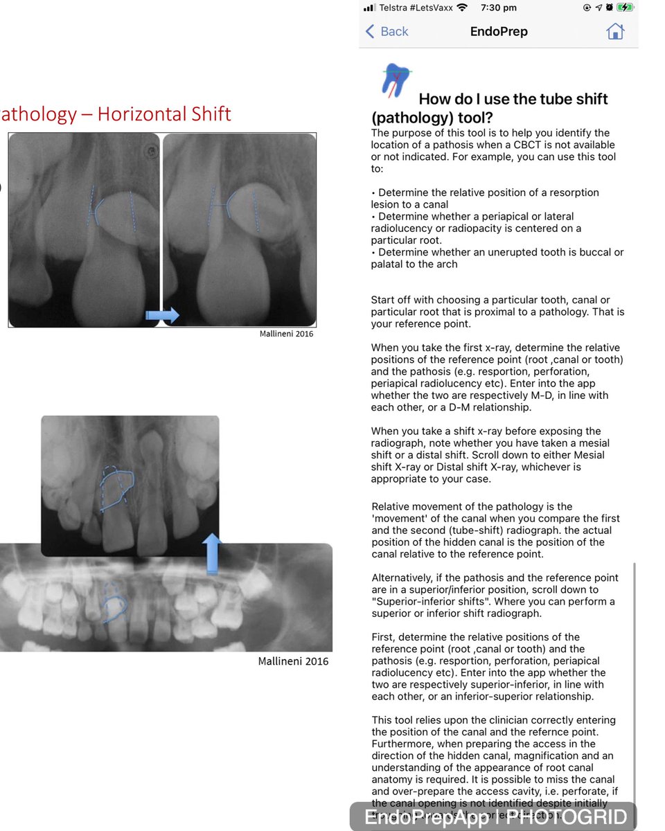 The tube shift calculator is an essential aspect of dentistry and can be challenging for those who do not use it regularly. It can be used for identifying the location of a pathosis, which is handy for those who do not have access to CBCT/CT.

It’s in the EndoPrep app ,