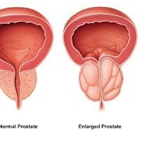 kjdelay1's tweet photo. Urology fact: A man with an “enlarged prostate” found during a rectal exam or on a CT scan who does not have symptoms does not need any further therapy or evaluation. https://t.co/ll5jQiRwqu