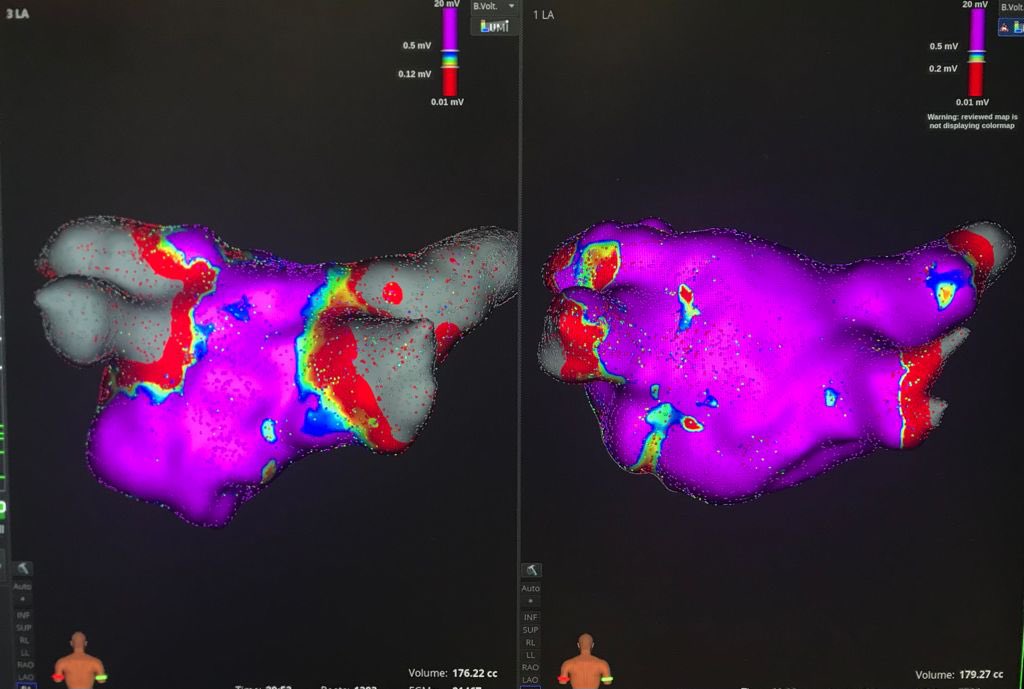 Reza Wakili (@wakilireza) on Twitter photo First Pulsed-Field-Ablation (PFA) procedures at the Westgerman Heart and Vascular Center in Essen. Very impressed by the new milestone in Electrophysiology #EPeeps. <a href="/TRassafMD/">Tienush Rassaf</a> <a href="/luedike/">Peter Lüdike</a> <a href="/maorban/">Mathias Orban</a> <a href="/UniklinikEssen/">Uniklinikum Essen</a> <a href="/DGK_org/">Deutsche Gesellschaft für Kardiologie</a> <a href="/AGEP_DGK/">AGEP</a> <a href="/Phiso_de/">Philipp Sommer</a> <a href="/papathanasiou_/">Maria Papathanasiou</a> <a href="/YoungDgk/">Young DGK</a> First Pulsed-Field-Ablation (PFA) procedures at the Westgerman Heart and Vascular Center in Essen. Very impressed by the new milestone in Electrophysiology #EPeeps. <a href="/TRassafMD/">Tienush Rassaf</a> <a href="/luedike/">Peter Lüdike</a> <a href="/maorban/">Mathias Orban</a> <a href="/UniklinikEssen/">Uniklinikum Essen</a> <a href="/DGK_org/">Deutsche Gesellschaft für Kardiologie</a> <a href="/AGEP_DGK/">AGEP</a> <a href="/Phiso_de/">Philipp Sommer</a> <a href="/papathanasiou_/">Maria Papathanasiou</a> <a href="/YoungDgk/">Young DGK</a>