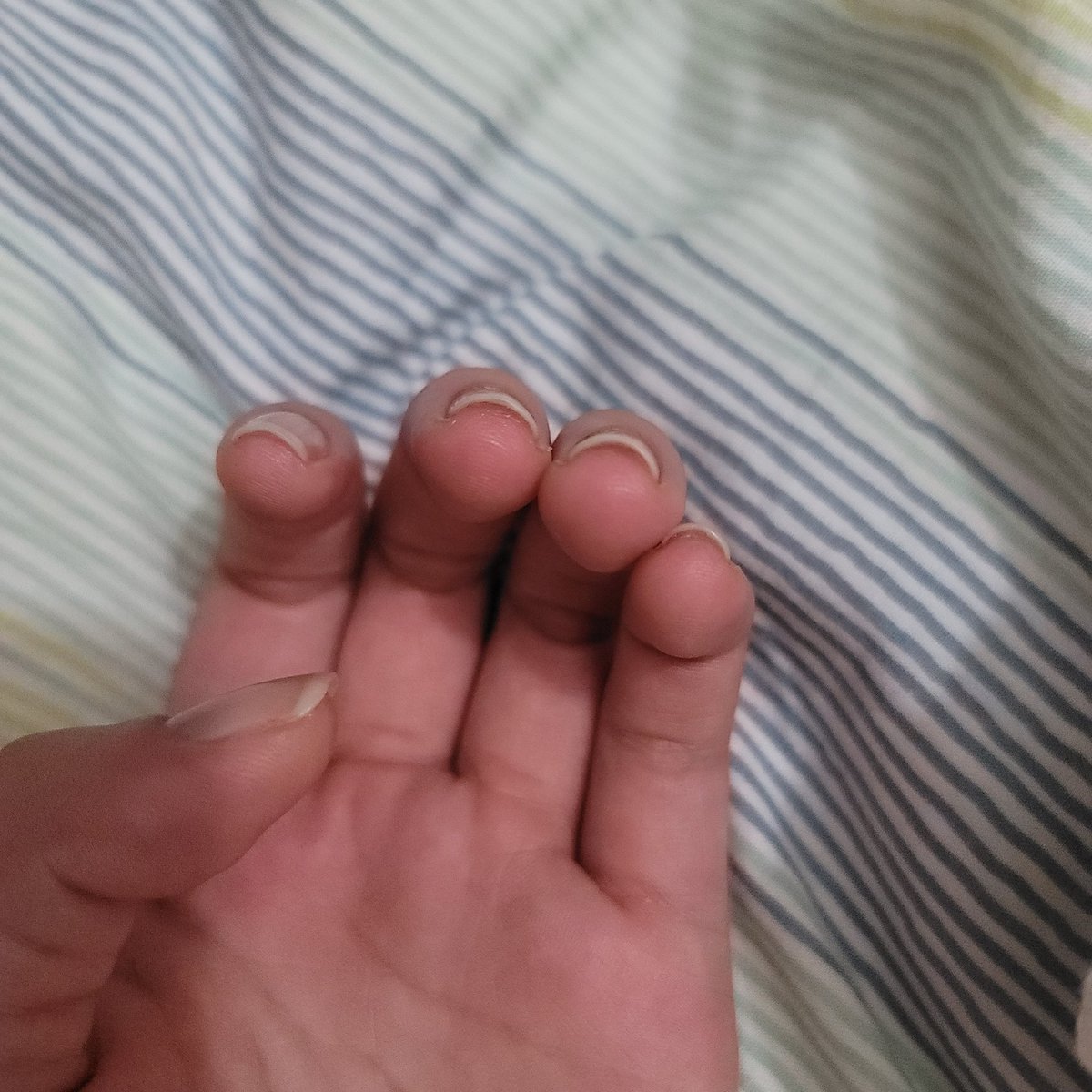 咲弥 元深爪の育爪記録 本日の爪 Twitter Day10 Nailenvy Day7 ちょっと今回の写真汚いかも 反り爪 若干巻き爪 右手薬指が酷く この通りなのでハイポも育ちにくい ネイルエンビーで爪を固めることが原因なら 外面からでなく内側から爪を厚くする