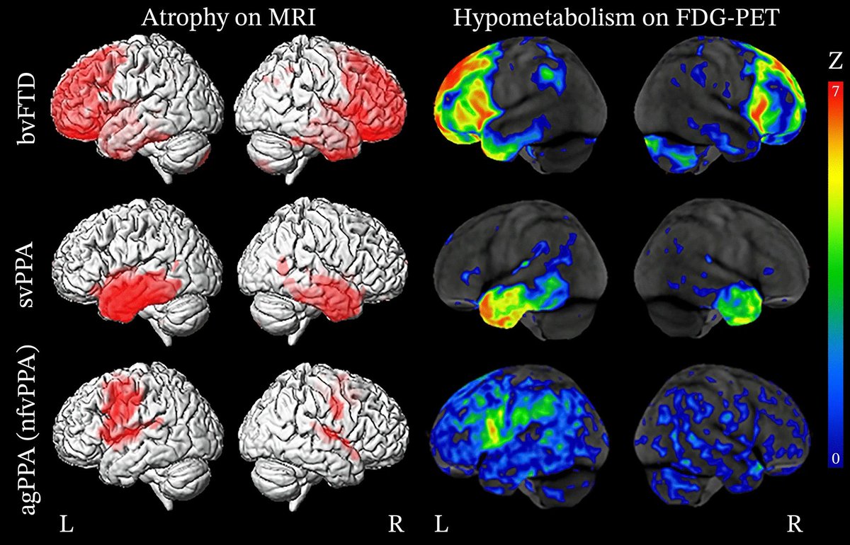 Neuroimaging in Frontotemporal Dementia: Heterogeneity and Relationships with Underlying Neuropathology. Review of neuroimaging and the phenotypic & pathologic features of FTD spectrum, as seen on MRI & PET. bit.ly/2YI0hjg @BradPeet @SalvoSpinaSF @mundada_nidhi @relajoie