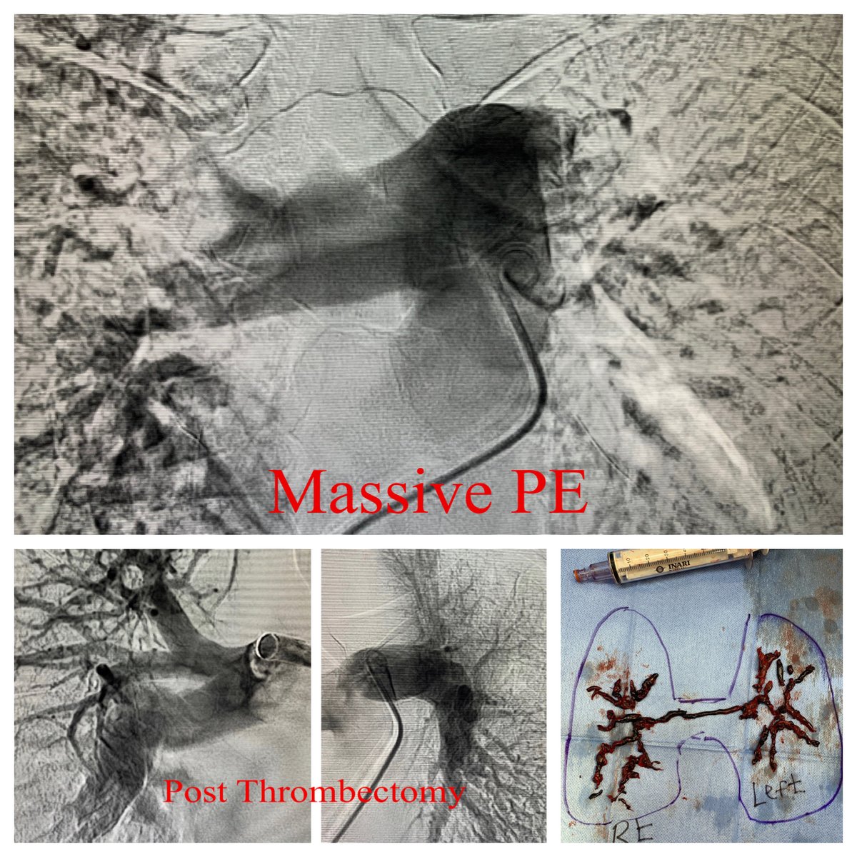 University of Cincinnati Interventional Radiology (@uc_vir) on Twitter photo Single session massive PE thrombectomy using 24 F #FlowTriever <a href="/InariMedical/">Inari, now part of Stryker</a> with <a href="/AMakramalla/">Abouelmagd Makramalla</a>
Impressive results <a href="/SIRspecialists/">Society of Interventional Radiology</a> <a href="/UCRadRes/">UCRadRes</a> Single session massive PE thrombectomy using 24 F #FlowTriever <a href="/InariMedical/">Inari, now part of Stryker</a> with <a href="/AMakramalla/">Abouelmagd Makramalla</a>
Impressive results <a href="/SIRspecialists/">Society of Interventional Radiology</a> <a href="/UCRadRes/">UCRadRes</a>