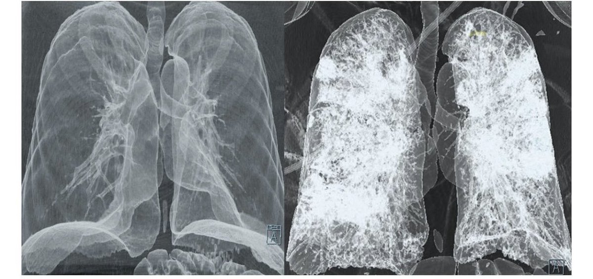 I’ve practiced at the ICU bedside in WA, AZ and OH since Mar 2020, going with teams of skilled providers to areas of need. Each time, we see the same story play out: lungs on the R ⬇️that could be saved by 2-doses of a vaccine.