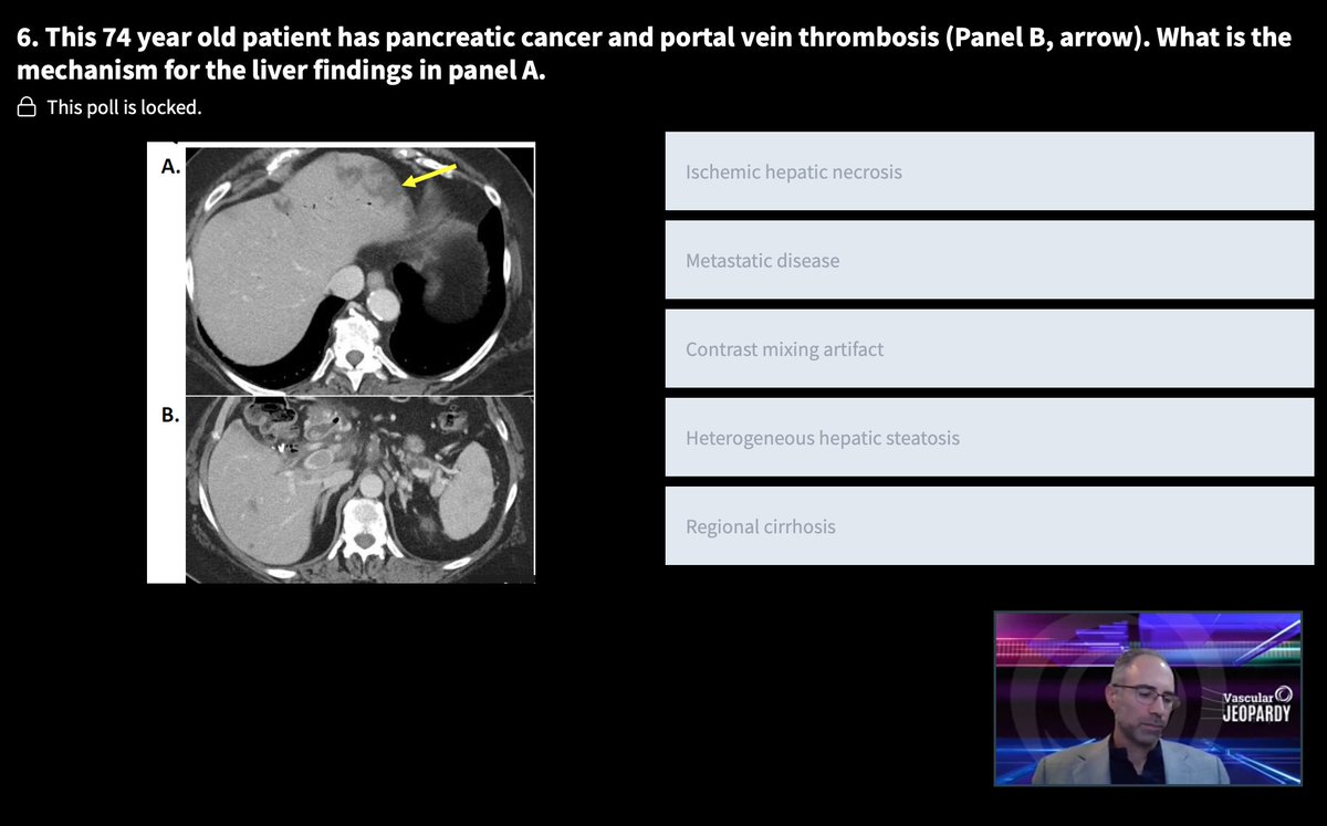 Ali Moran (@alimoranvascmed) on Twitter photo This is showing heterogenous hepatic stenosis! <a href="/SVM_tweets/">Society for Vascular Medicine | SVM</a> #SVM21 This is showing heterogenous hepatic stenosis! <a href="/SVM_tweets/">Society for Vascular Medicine | SVM</a> #SVM21
