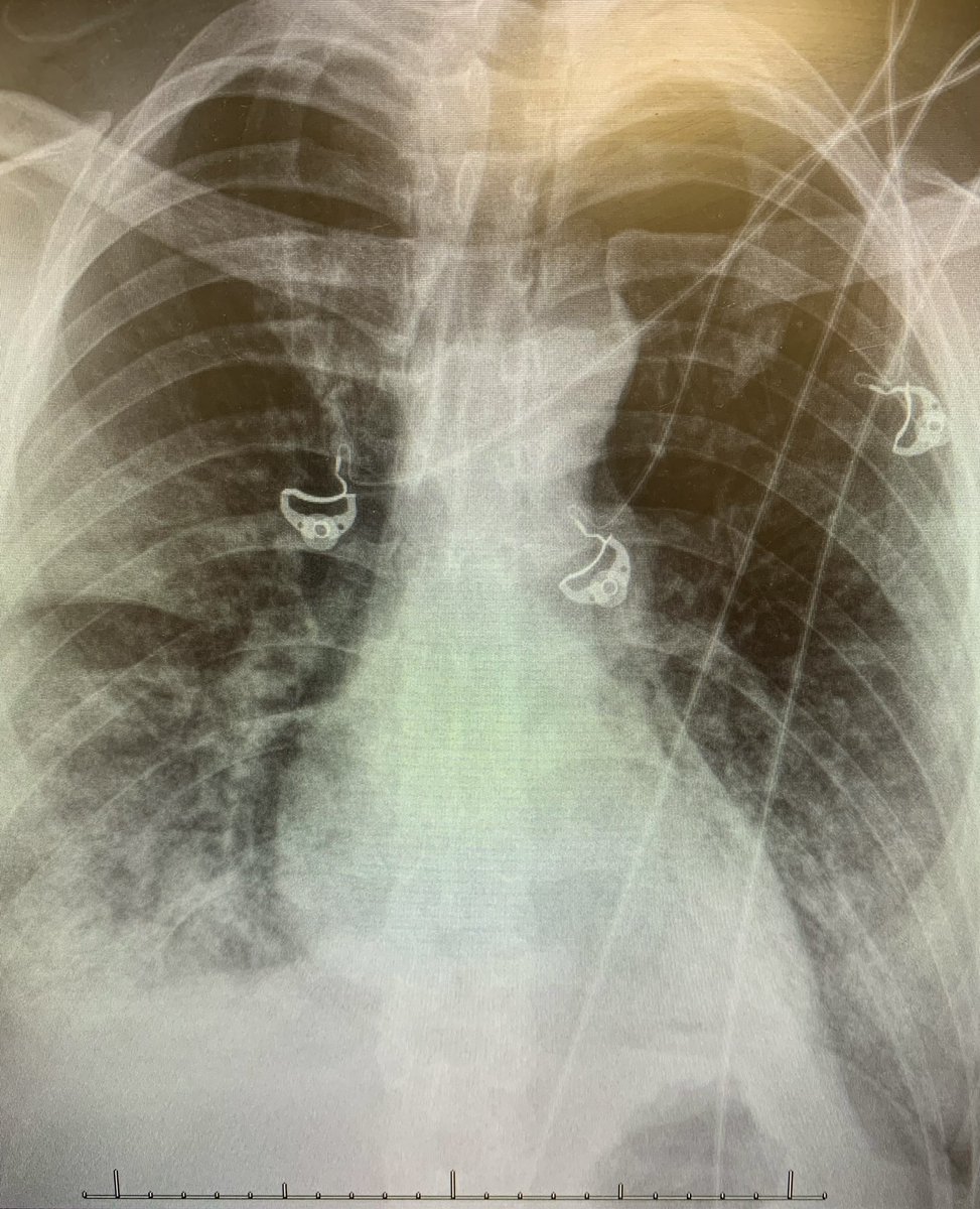 Unvaccinated, healthy, mid 20’s…COVID-19 positive.
ICU, ventilator…life forever changed.
Please, please, please get vaccinated. #Covid_19 #ThisIsOurShot