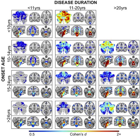 Sidhant Chopra (@sidchop) on Twitter photo Happy to see this out. Many years of work led by <a href="/ihharding/">Ian Harding</a>, and a huge team involved. The power of the ENIGMA framework shines in rare diseases:
Brain Structure and Degeneration Staging in Friedreich Ataxia
onlinelibrary.wiley.com/doi/abs/10.100β¦ <a href="/enigmabrains/">ENIGMA Consortium</a> @harding_lab <a href="/ANA_journals/">ANA Journals</a> Happy to see this out. Many years of work led by <a href="/ihharding/">Ian Harding</a>, and a huge team involved. The power of the ENIGMA framework shines in rare diseases:
Brain Structure and Degeneration Staging in Friedreich Ataxia
onlinelibrary.wiley.com/doi/abs/10.100β¦ <a href="/enigmabrains/">ENIGMA Consortium</a> @harding_lab <a href="/ANA_journals/">ANA Journals</a>