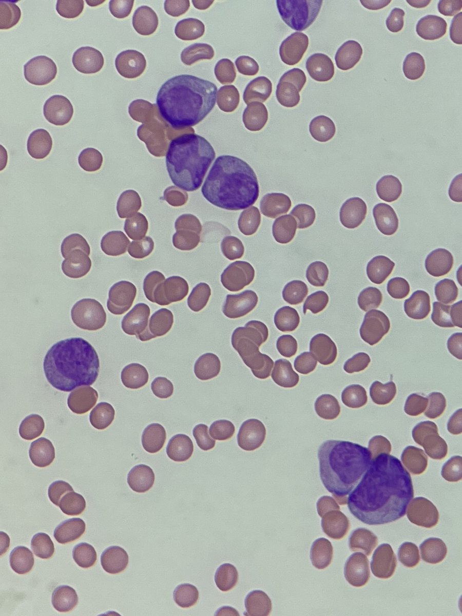BloodScientist's tweet photo. #MorphologyMonday

This peripheral blood film had been sitting in one my boxes and having taken these pictures, I thought it would be a good one to share. What do you think?

#underthescope #biomedicalscientist #haematology https://t.co/Wc0uNdQH6p