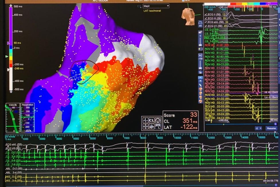 Post OS ASD flutter…Gone with a single burn…⁦<a href="/sabarisarav/">sabari saravanan</a>⁩ ⁦<a href="/Yogesh_EP/">Yogesh</a>⁩ …