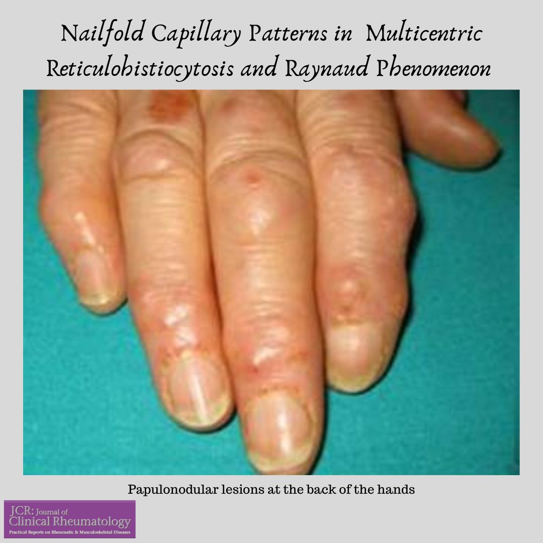 JCR: Journal of Clinical Rheumatology on Twitter: JCR: Journal of Clinical Rheumatology on Twitter: