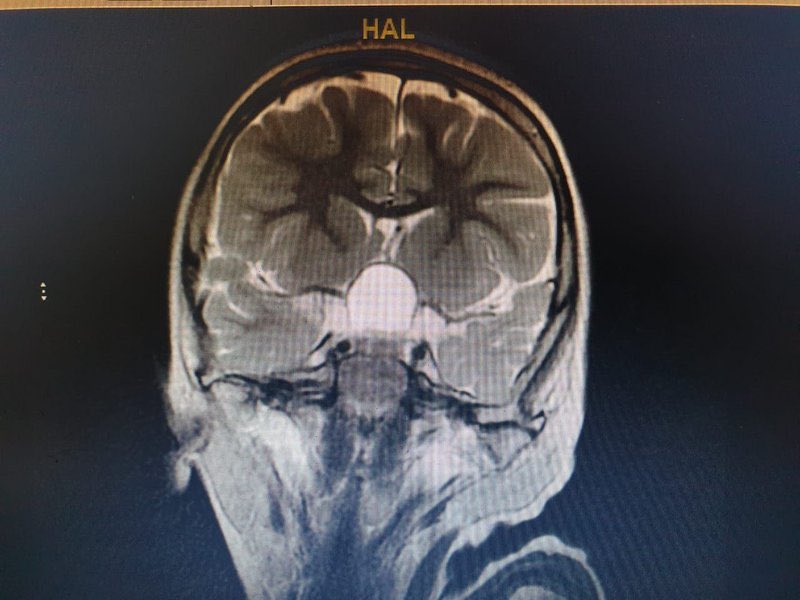 عملية هي الأولى من نوعها بالمجمع واستمرت 7 ساعات
إزالة ورم بِقَاعِ الجمجمة يُعيد "الإبصار" لطفل بمجمع الملك فيصل بـ #الطائف