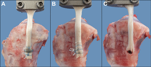 OJSM_SportsMed's tweet photo. Back to the future? This German cadaveric biomechanical study shows that bone staples provide a reliable alternative to interference fixation for #MCL reconstruction. Read more https://t.co/so82n9pteS @UK_Muenster #biomechanics #MCLreconstruction #sportsmedicine https://t.co/QXG2mYHBdf