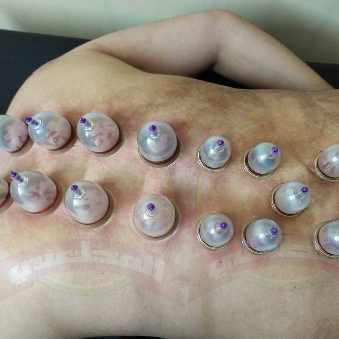AlmtanyHijama's tweet photo. #جلسة_حجامة_تنشيطية_للجسم
الحجامة فيها فائدة عظيمة

مركز المطعني للحجامة
خبرة أكثر من 9 سنوات ولله الحمد
 #آلام_العظام #العمود_الفقري #غضروف #فقرات_الظهر #القطنية #فقرات_الرقبة #الخشونة #آلام_المفاصل #الركبة #الكتف #الحجامة #إلتهاب_الأعصاب #إلتهابات #المناعة
#خبرة_9_سنوات https://t.co/mWASvHM0dG