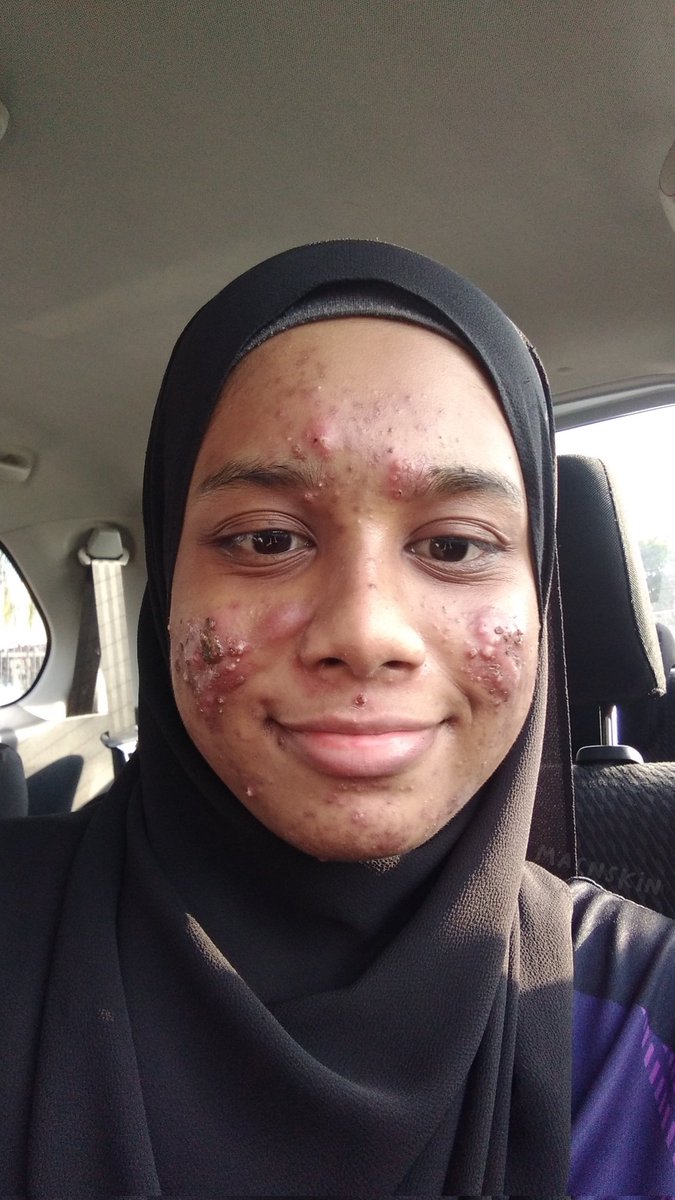enaatato_'s tweet photo. omg takut gilaaa nak post but heres my not-so-glow-up flex!

the skin                              the skincare https://t.co/PMBJqc6lJv