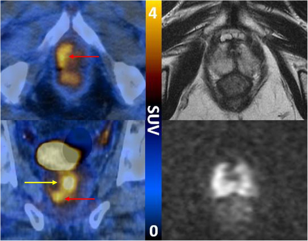 EUplatinum's tweet image. The Additive Diagnostic Value of PSMA PET-CT to mpMRI Triage in the Diagnosis of Prostate Cancer (PRIMARY): A Prospective Multicentre Study

buff.ly/3ymlXh3

@drlouiseemmett @DrMHofman @declangmurphy @lawrentschuk @DrHWoo @DrVenuC