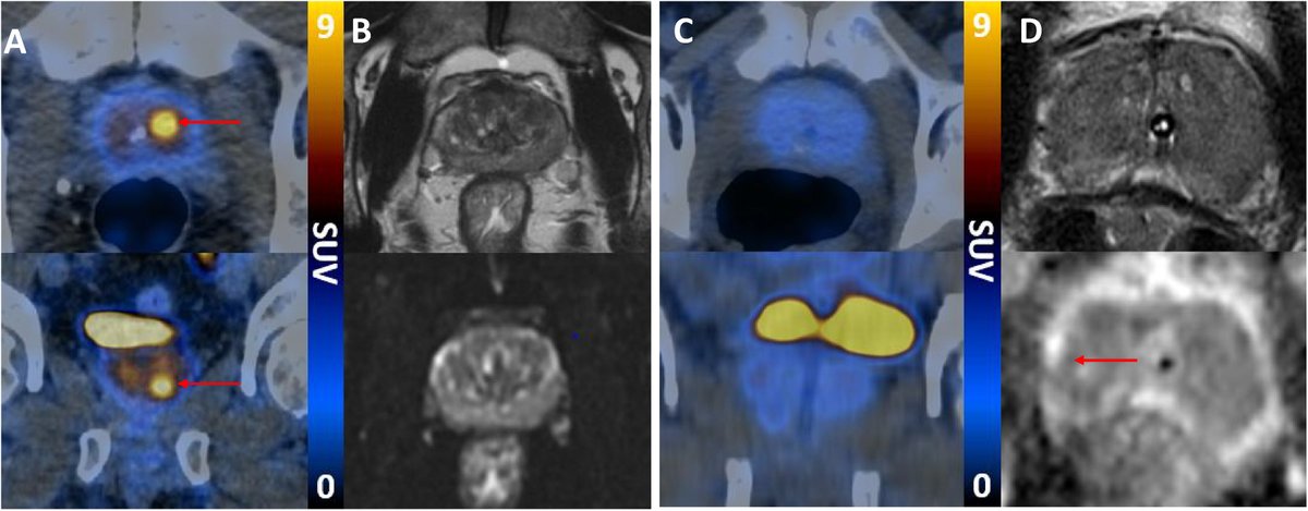 EUplatinum's tweet image. The Additive Diagnostic Value of PSMA PET-CT to mpMRI Triage in the Diagnosis of Prostate Cancer (PRIMARY): A Prospective Multicentre Study

buff.ly/3ymlXh3

@drlouiseemmett @DrMHofman @declangmurphy @lawrentschuk @DrHWoo @DrVenuC