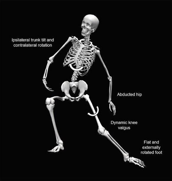IMechanisms's tweet image. Now confirmed right ACL tear for Wolfsburg’s Xaver Schlager.
Why we sounded alarm 🔔:
▪️Non contact injury
▪️Foot plant, changed direction trying to regain balance
▪️Immediate collapse

Thanks to @FDellaVilla for pic (right) showing point of no return

#Bundesliga #VfLWolfsburg
