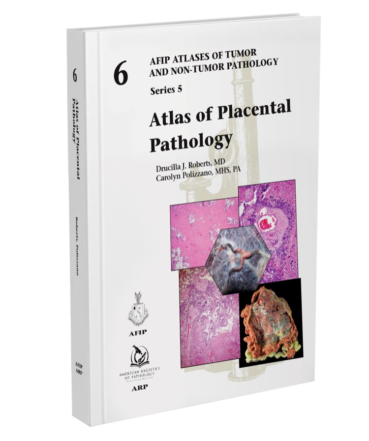 Available Now! 

Atlas of #PlacentalPathology by Drs. Roberts & Polizzano, MHS, PA.
 
Ready to ship starting today: arppress.org.

#placentalpath #skinpath #pathology #tumor #pathresidents