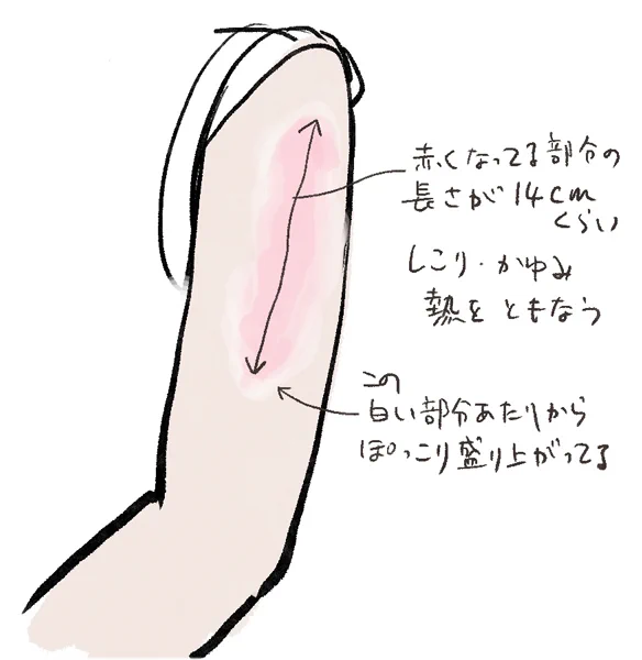 モデルナアーム発現したんですが、昨日は7〜8㎝だった腫れが今日は倍になってて驚きました
腕も上がるようになったし、特に痛みはないです
私の写真ではお見苦しいのでイラストで
分かりやすいように描いたので濃いめですが、ピンクの部分はもっと斑ら… 