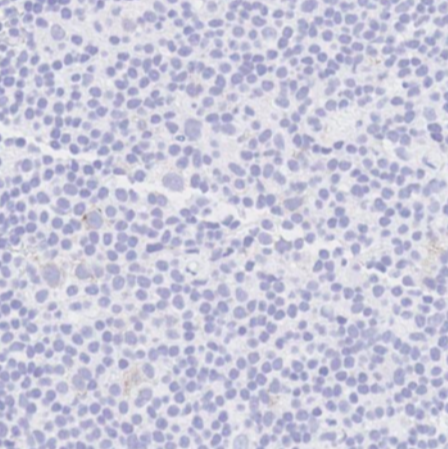 SibaElHussein's tweet photo. #LessonsfromtheFridayUnknowns relapsed classic Hodgkin lymphoma with loss of CD30 expression in the setting of Brentuximab therapy, shown by @ljmedeirosMD during #LJMFridayUnknowns ➡️ https://t.co/ueGIAtYiEZ #hemepath #pathtwitter #lymsm 
@KirillLyapichev @RMirandaMD @Dowhankim https://t.co/Mi7dz1RMTU