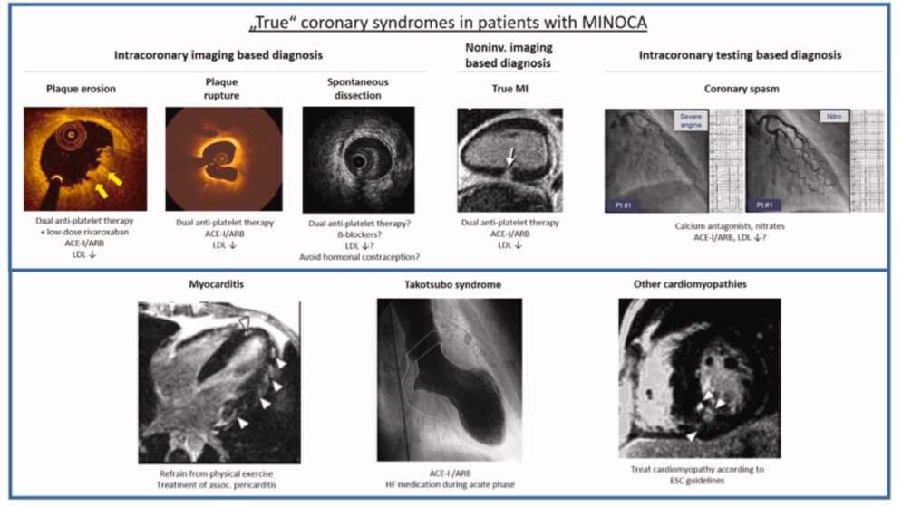 Diagnostic work-up in MINOCA
