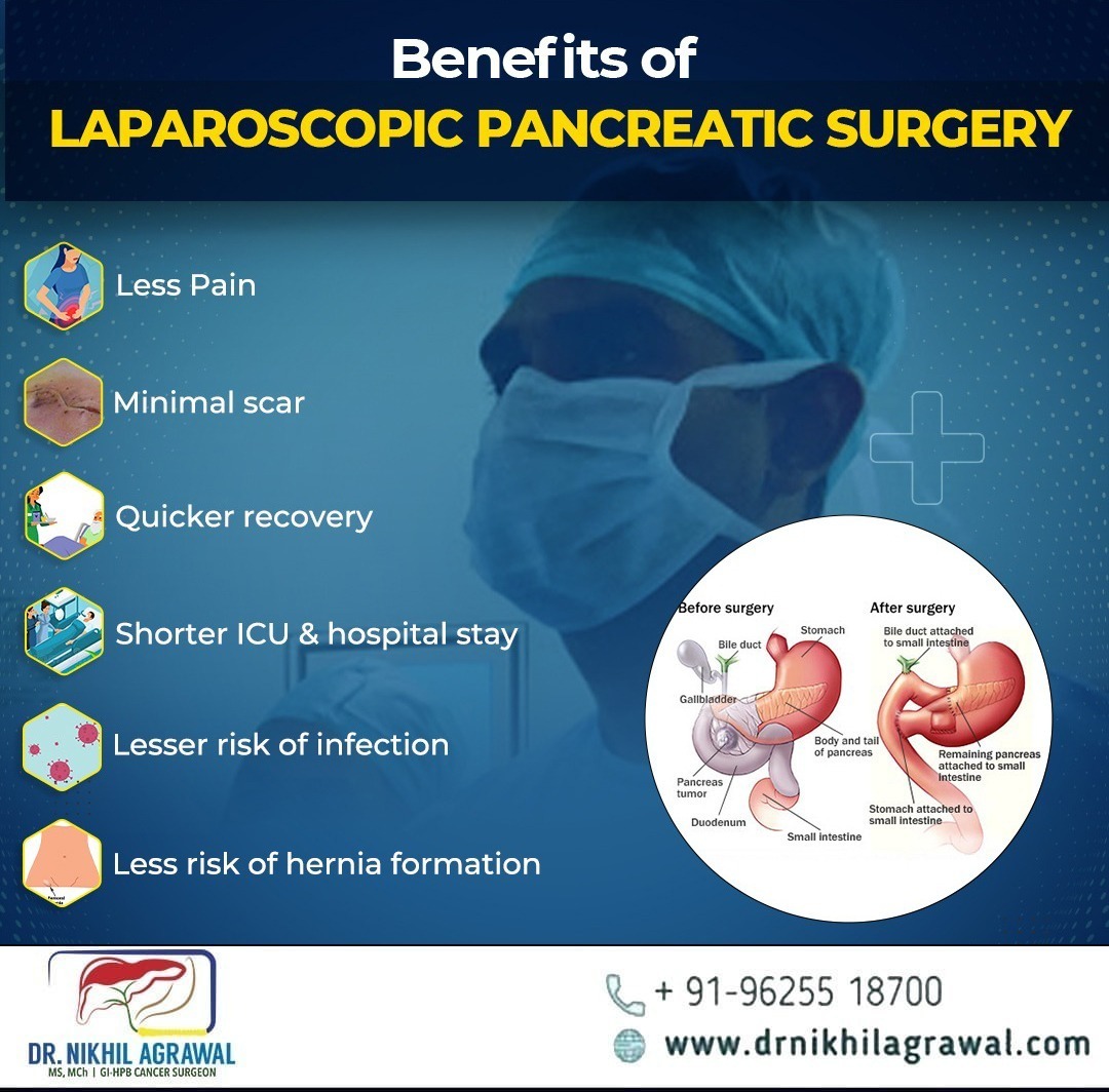 Benefits of Laparoscopic pancreatic surgery procedure is that it is minimally invasive surgery.

Click here:  bit.ly/panc-cyst

#pancreatic #laparoscopic #pancreaticsurgery #benefits #lesspain #Delhi #gastrointestinal #lesspain