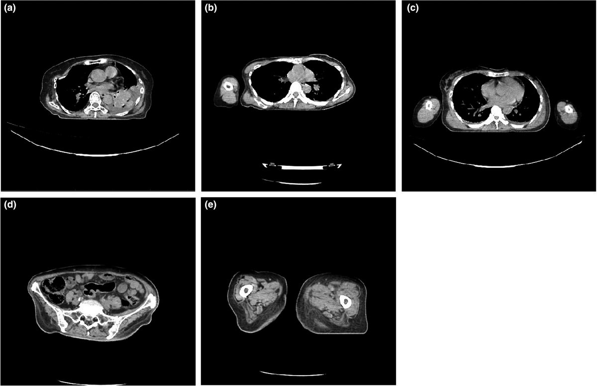 driitb's tweet photo. Researchers @itbofficial @csuci @undip develop an #algorithm for the automated calculation of water-equivalent diameter and size-specific dose estimation from clinical computed tomography images containing one or more substantial body parts. https://t.co/GQpehqNfYF
#ITBresearch https://t.co/oeYW8BLuh5
