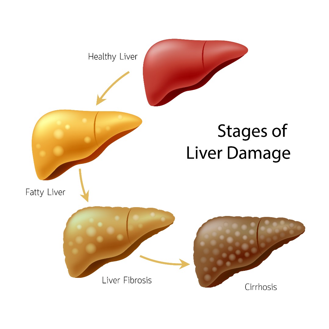 Pinnacle_TX's tweet photo. #Cirrhosis is when your liver is severely scarred & permanently damaged. The stages prior to cirrhosis can be reversed with diet, exercise & management of symptoms. With cirrhosis, we can only manage symptoms to prevent further diseasae, like cancer. #LiverHealth #SaveYourLiver https://t.co/qC9GdsQy2y