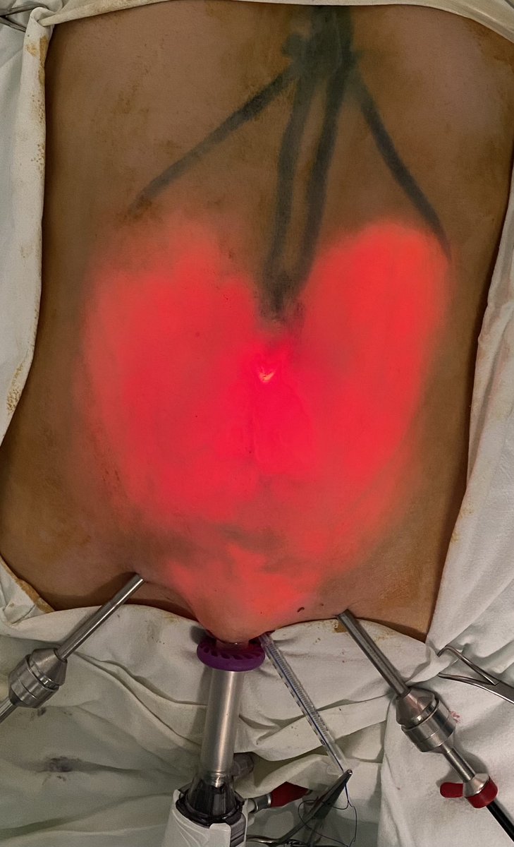 Love is All Around❤️
 #SubCutaneous OnLay Endoscopic Approach Mesh Repair for Umbilical Hernia with Diastasis Recti
 #SCOLA