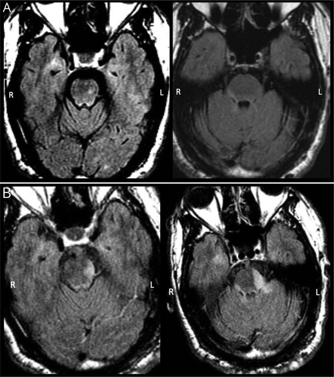 NeurologyCP's tweet image. Dancing Larynx Syndrome Associated With #Trigeminal Neuralgia Secondary to #MultipleSclerosis bit.ly/3joYqaW #NeuroTwitter