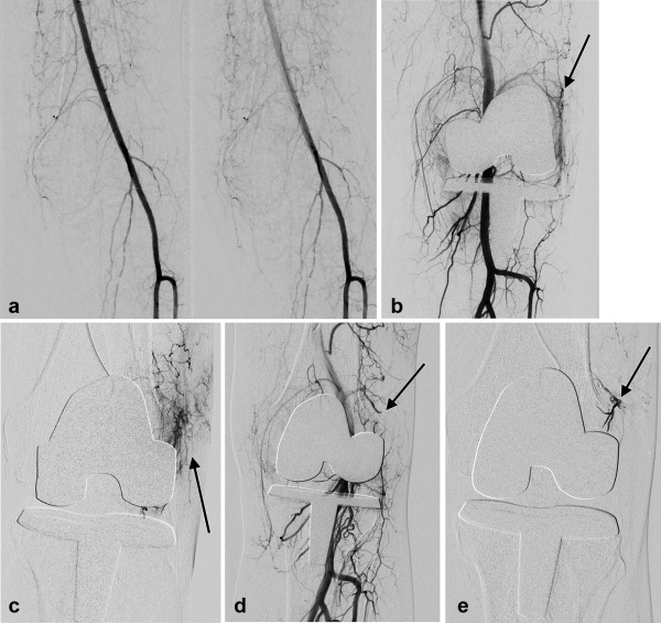 Genicular Artery Embolization for Refractory Hemarthrosis following Total Knee Arthroplasty: Technique, Safety, Efficacy, and Patient-Reported Outcomes. bit.ly/3CqWF4k @JHomonoff <a href="/sirish_kishore/">Sirish Kishore</a> <a href="/LisaAMandlMD/">Lisa A. Mandl MD MPH</a> <a href="/HipKneeDocNYC/">Geoffrey Westrich</a> #irad