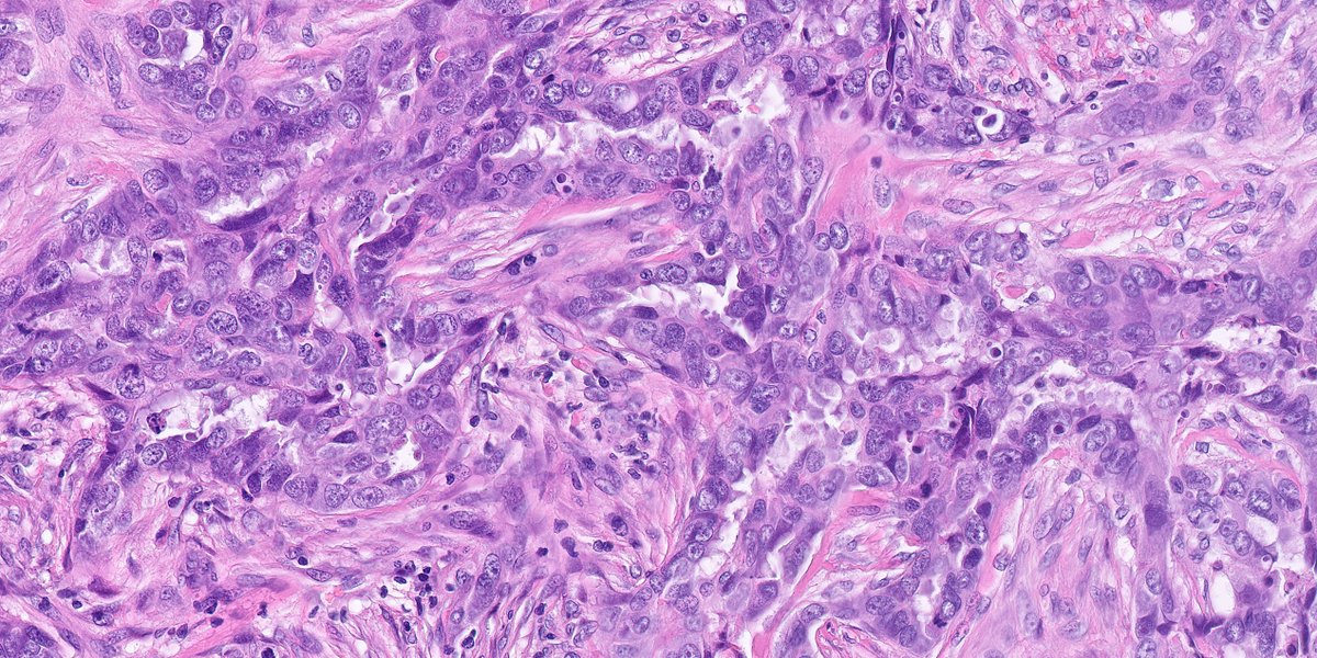 1/ #breastpath lovers, have you heard about this new entity of "serous carcinoma-like" breast carcinoma? 😉
#pathology #IHCpath- the IHCs showed negativity for ER, PR, HER2, GATA3, Sox10