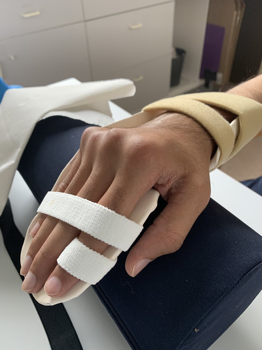 Today’s splinting session with <a href="/franbinns/">eleanor binns</a>
It was great to see how this splint turned out! 😊
Each splint made is customised and unique to fit individuals needs. 
(Gained consent to share this imagine)